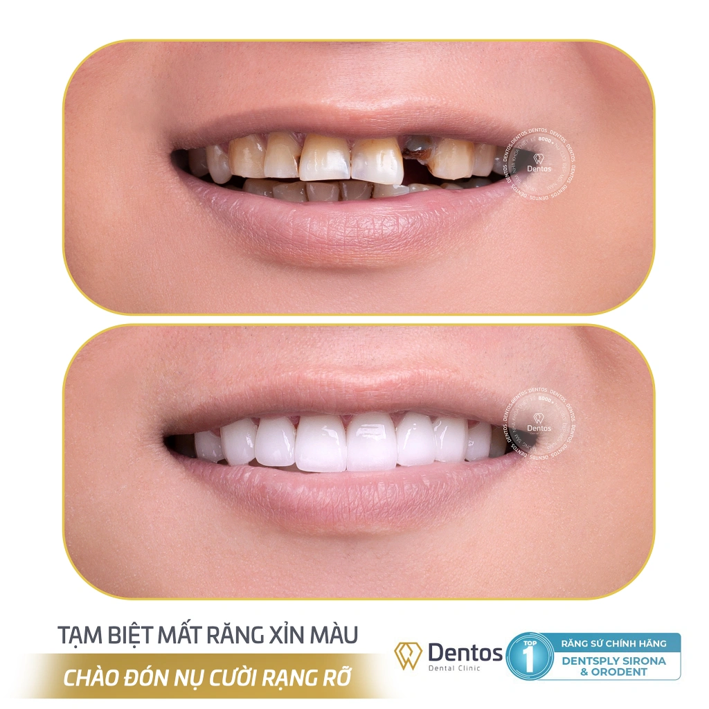 Bọc răng sứ 1 hàm cải thiện khả năng ăn nhai và thẩm mỹ